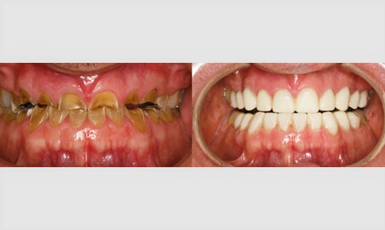 Full mouth Rehabilitation 1